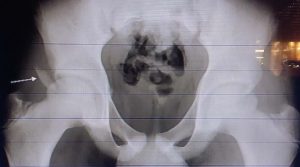 L’ostéochondrose de la crête iliaque antéro supérieure et inférieure